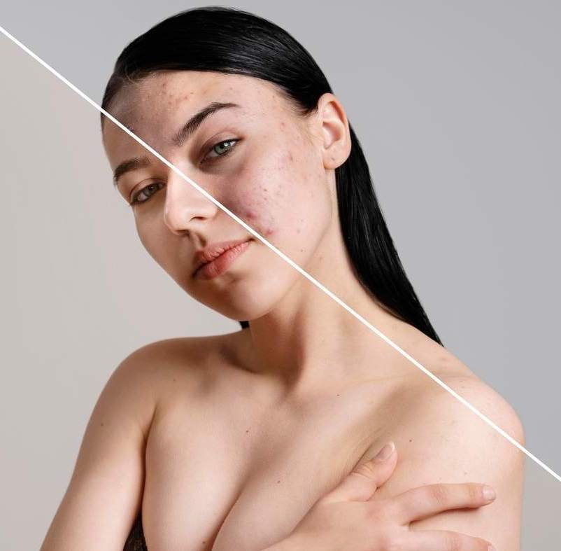 Acne Behandeling home pagina Nawad Beauty Clinic