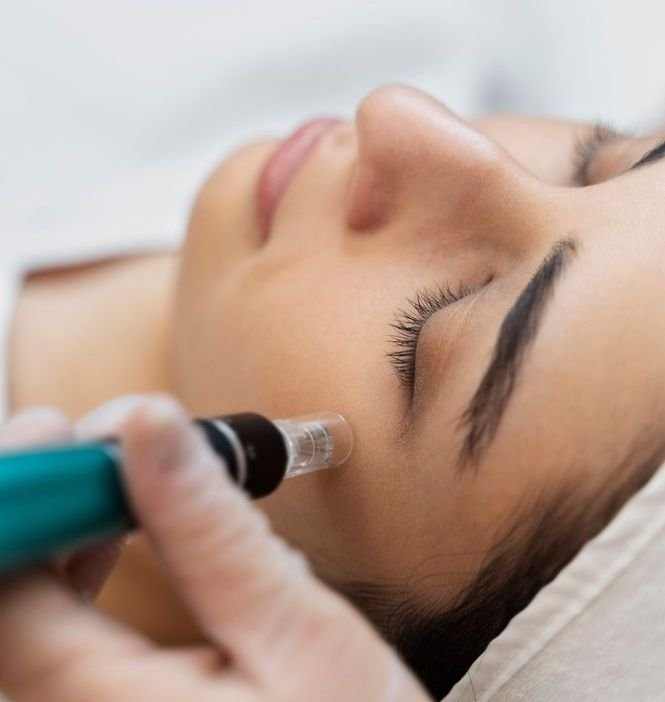 Carbon Laser Peeling home pagina Nawal Beauty Clinic